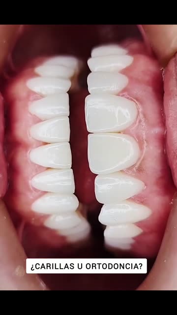 Carillas: un resultado muy natural - Clínica Sonrilaser Cúcuta