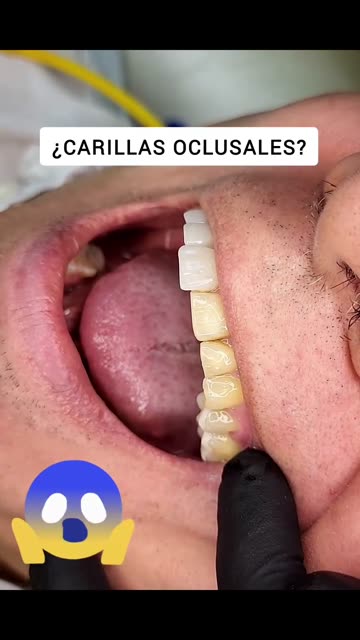 Carillas oclusales para proteger molares - Clínica Sonrilaser Cúcuta