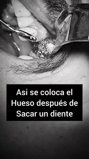 ¿Cómo se coloca el hueso en el maxilar? - Clínica Sonrilaser Cúcuta