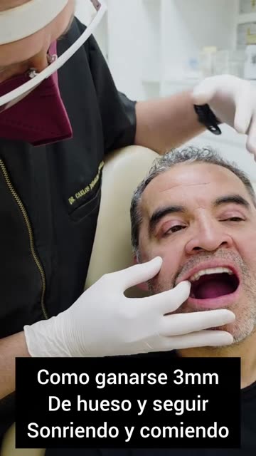 Hueso anterior y seguir sonriendo - Clínica Sonrilaser Cúcuta
