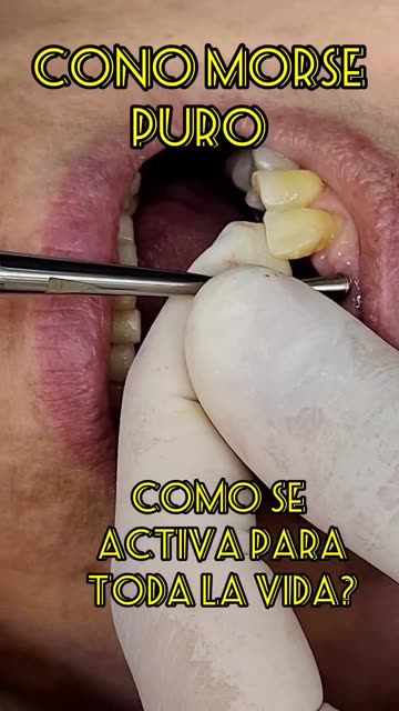 Implantes cono morse: solidez para toda la vida - Clínica Sonrilaser Cúcuta