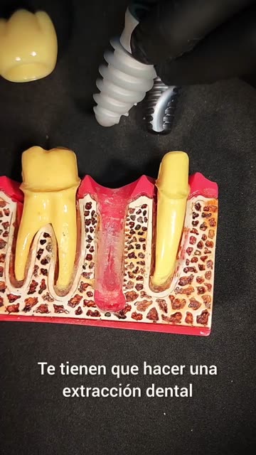 Implantes inmediatos - Clínica Sonrilaser Cúcuta