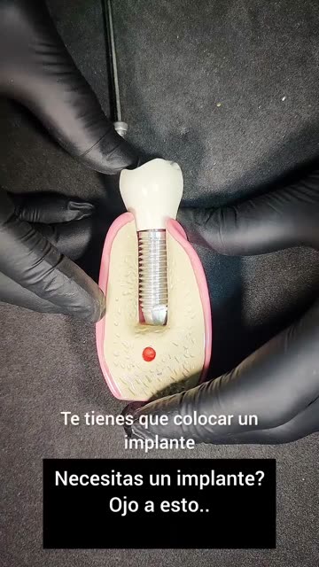 Implantes sólidos y con cero gap - Clínica Sonrilaser Cúcuta