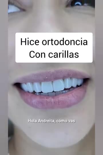 Ortodoncia con carillas - Clínica Sonrilaser Cúcuta