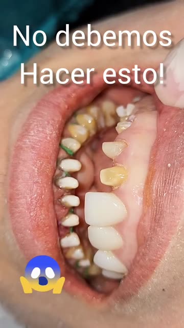 ¡Esto no se hace! Consejos de ortodoncia - Clínica Sonrilaser Cúcuta