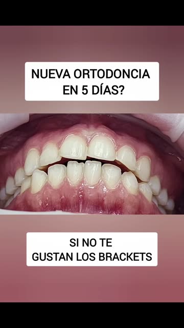 Ortodoncia en solo 5 días - Clínica Sonrilaser Cúcuta
