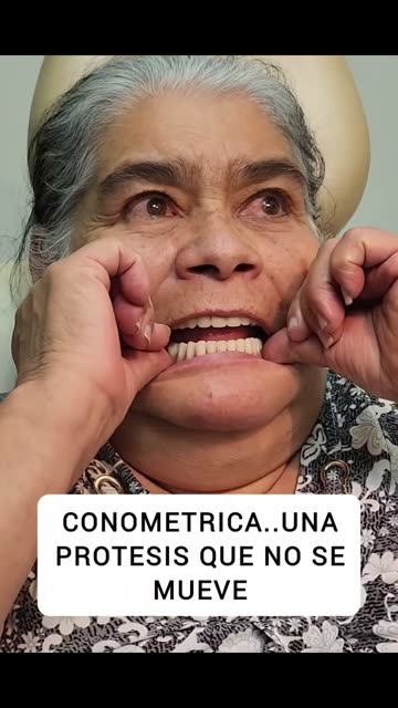 Prótesis conométricas: como prótesis fijas - Clínica Sonrilaser Cúcuta