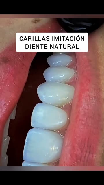 Prueba de carillas - Clínica Sonrilaser Cúcuta