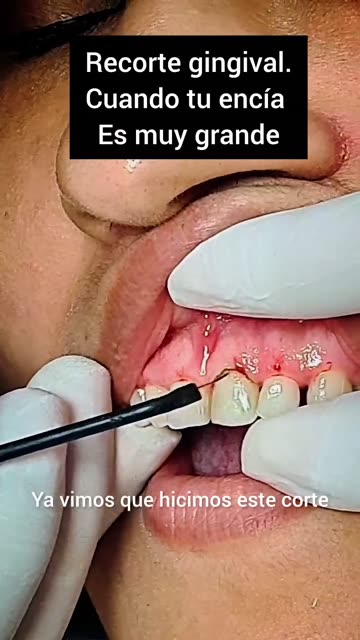 Sonrisa gingival: una solución - Clínica Sonrilaser Cúcuta